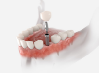 Dental-Implants-Sydney