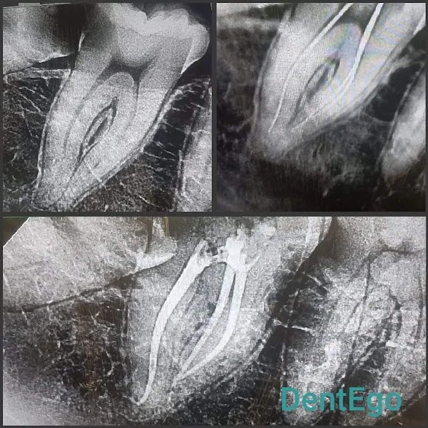 Root Canal Treatment