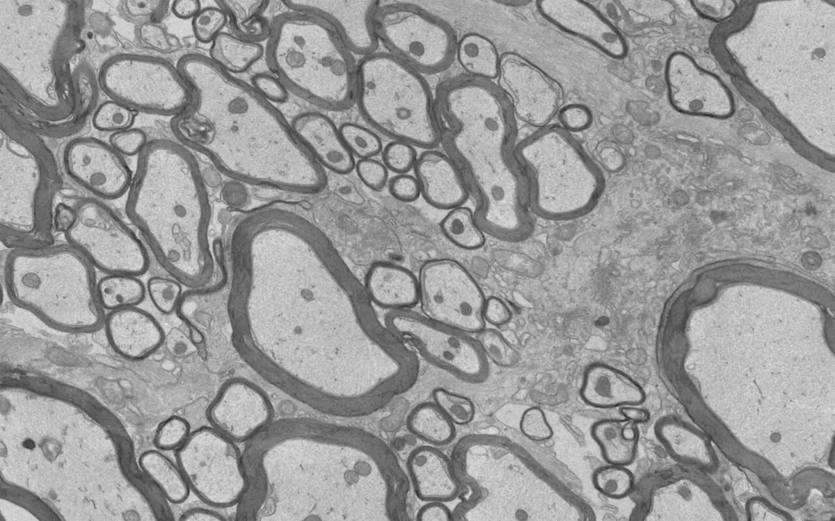 New Treatments Boost Myelin Repair in MS Models