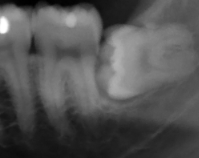 Wisdom Teeth Removal Melbourne Wisdom-Teeth-Removal-Melbourne