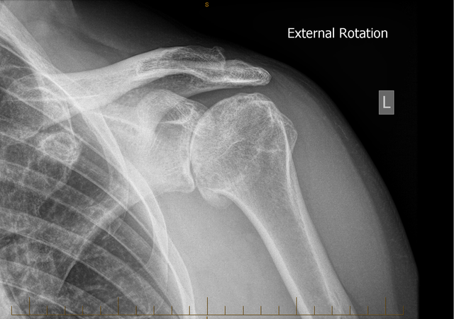 Left-Shoulder-external-rotation