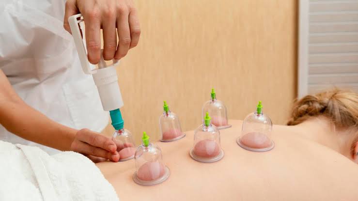 Hijama Therapy