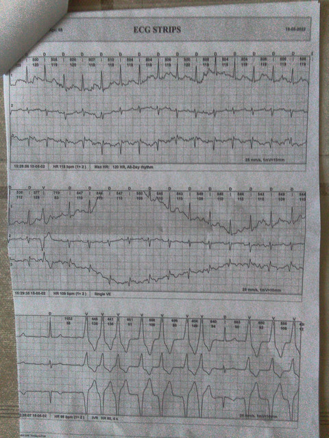 EKG-5