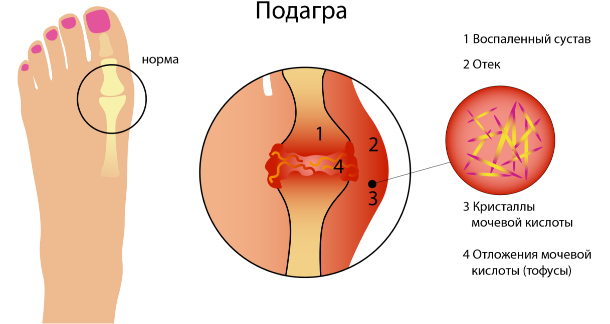 Подагра