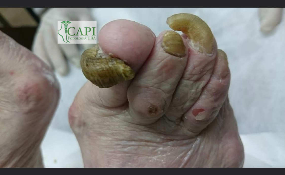 Tratamiento de onicolisis y uñas engrosadas