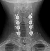 Posterior cervical fusion lateral mass screws