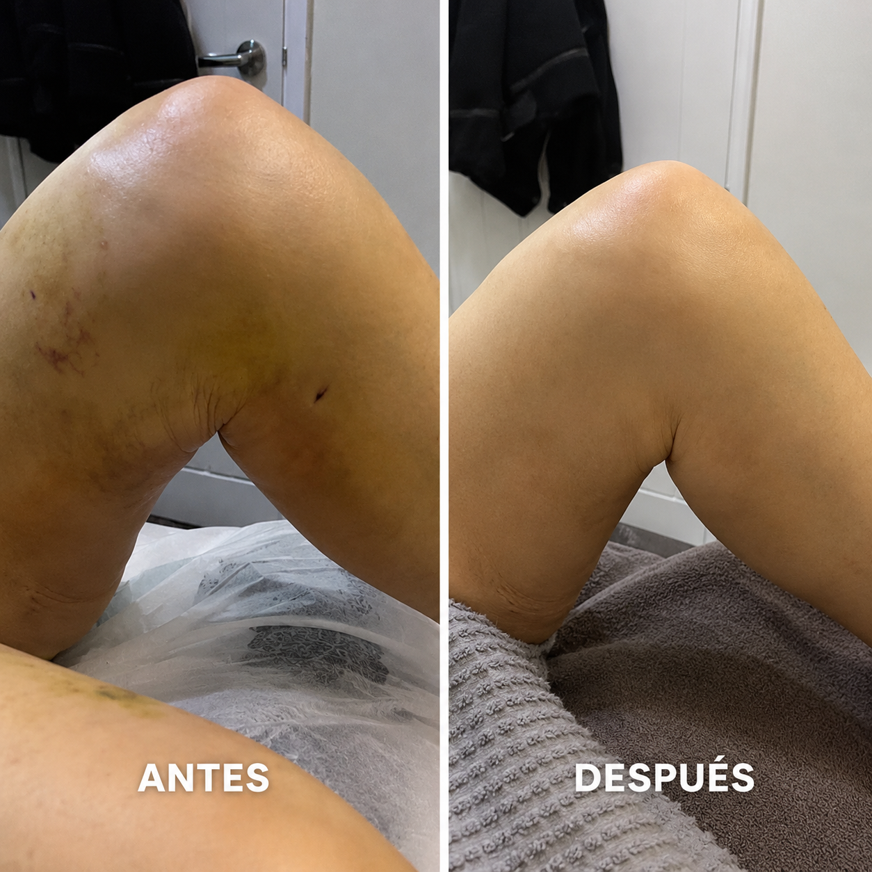 Antes y después rodilla — várices y retención