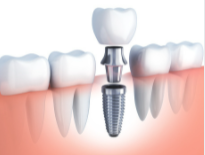 Dental-implants-in-Sydney