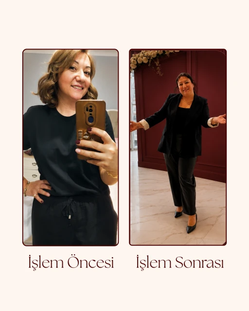 G5 Öncesi Sonrası 4