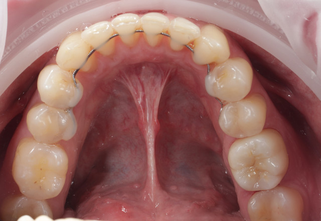 Przypadek 3 — implantologia Smile by Smile Wrocław