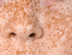 Pecas en el rostro