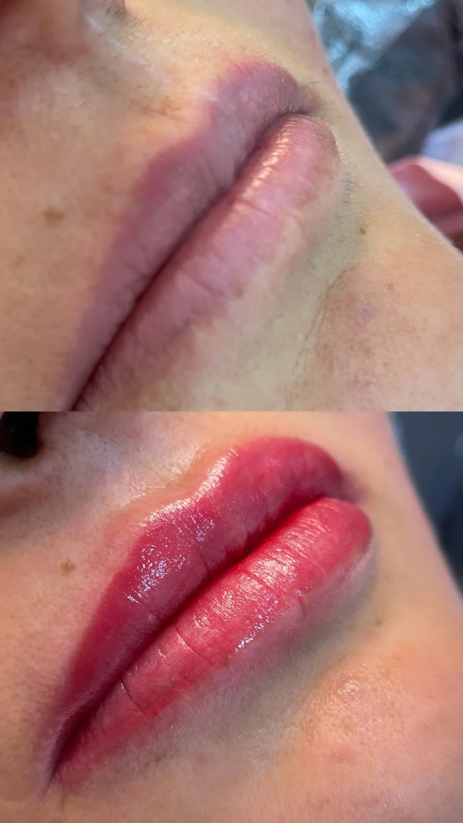 Revitalização Labial