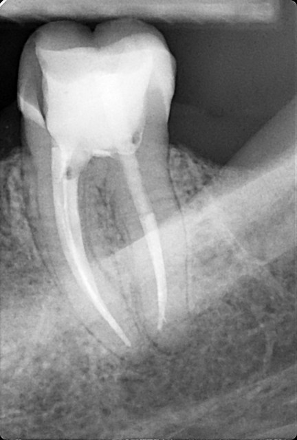 RTG: powtórne leczenie endodontyczne przed implantacją