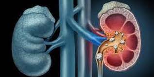 Kidney Stone Detection preview