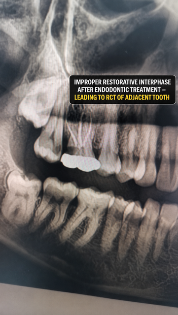 Clinical photographs of teeth showing common restorative pitfalls