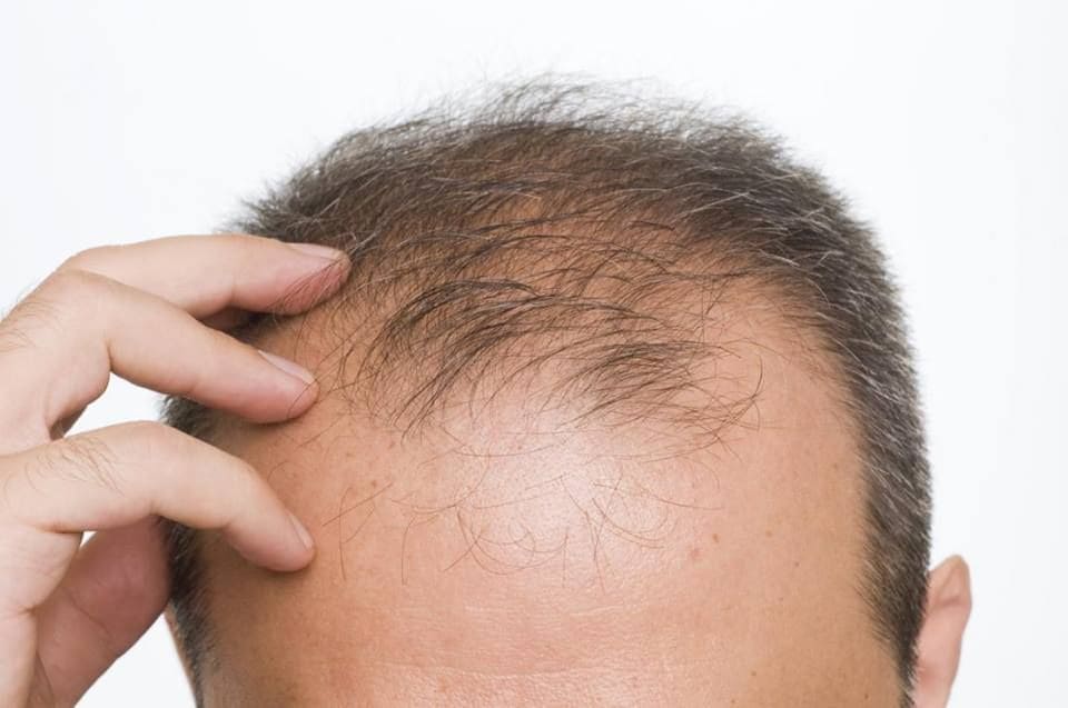 Se te cae el pelo