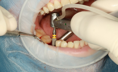 Dental-Implants