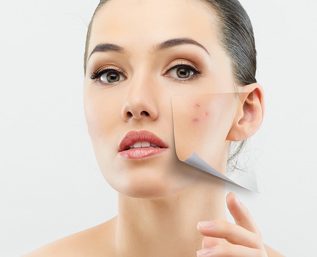 Acne3.jpg