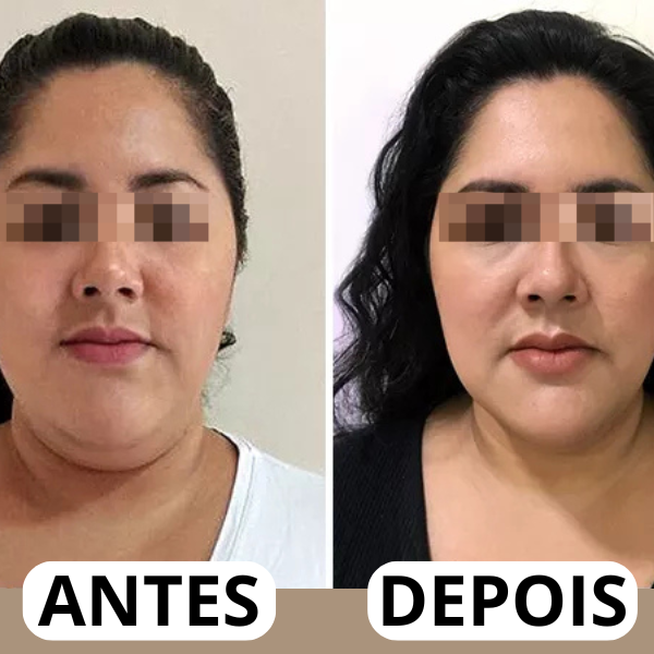 Resultado real antes e depois da papada 4