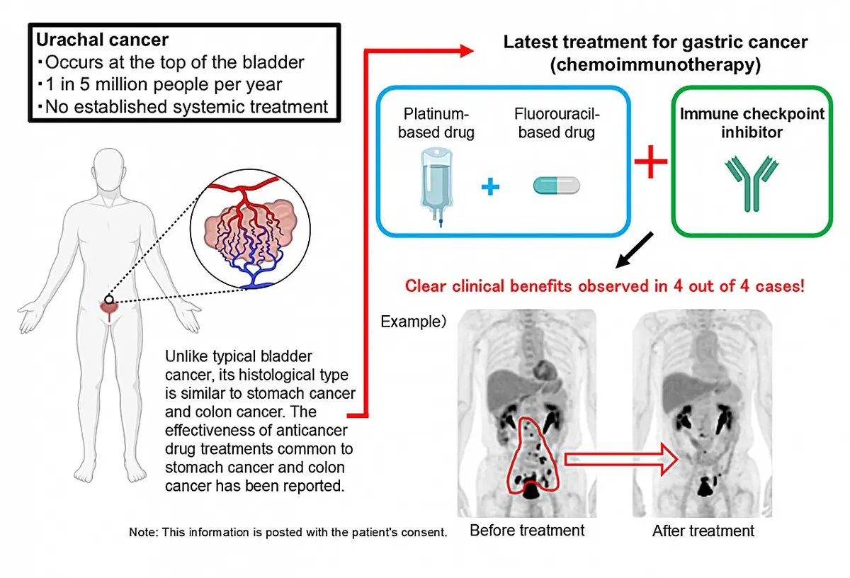 Chemoimmunotherapy Shows Promise for Ultra-Rare Urachal Cancer