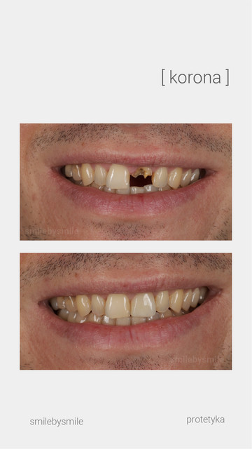 Korony przed i po #8 – Smile by Smile Wrocław