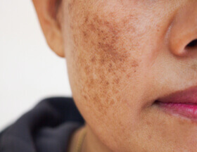 Melasma en el rostro