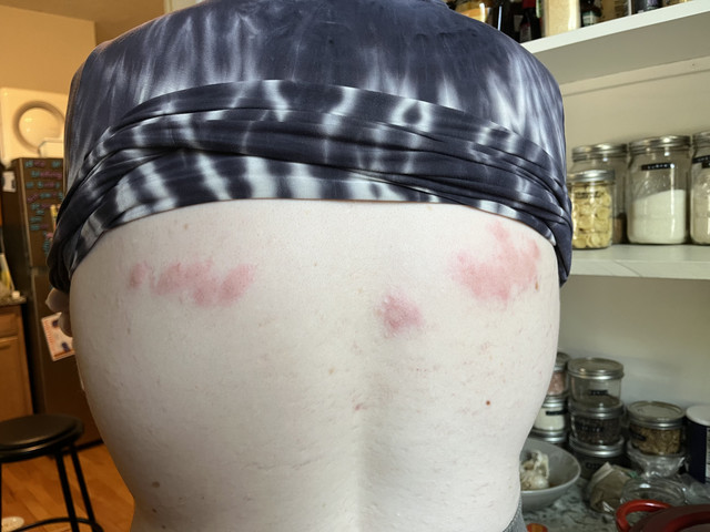 rash5
