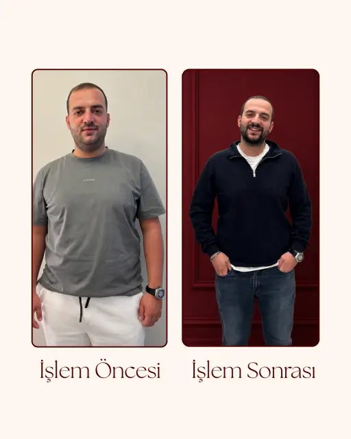 G5 Öncesi Sonrası 8