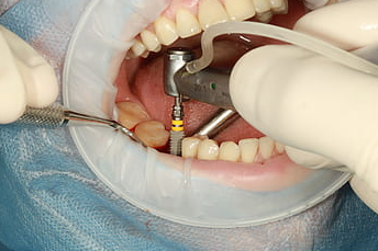 Dental-Implants-Melbourne