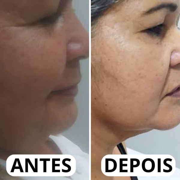 Resultado real antes e depois da papada 7