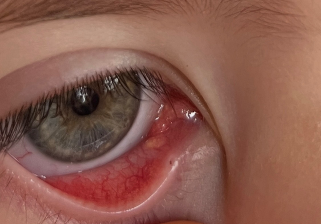 eye