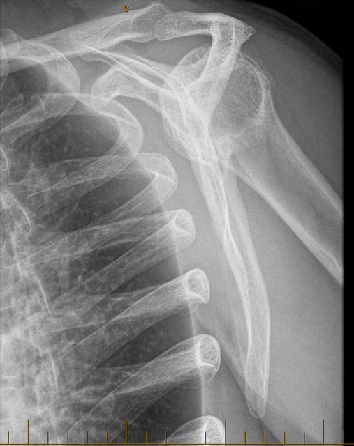 Left-Shoulder-scap