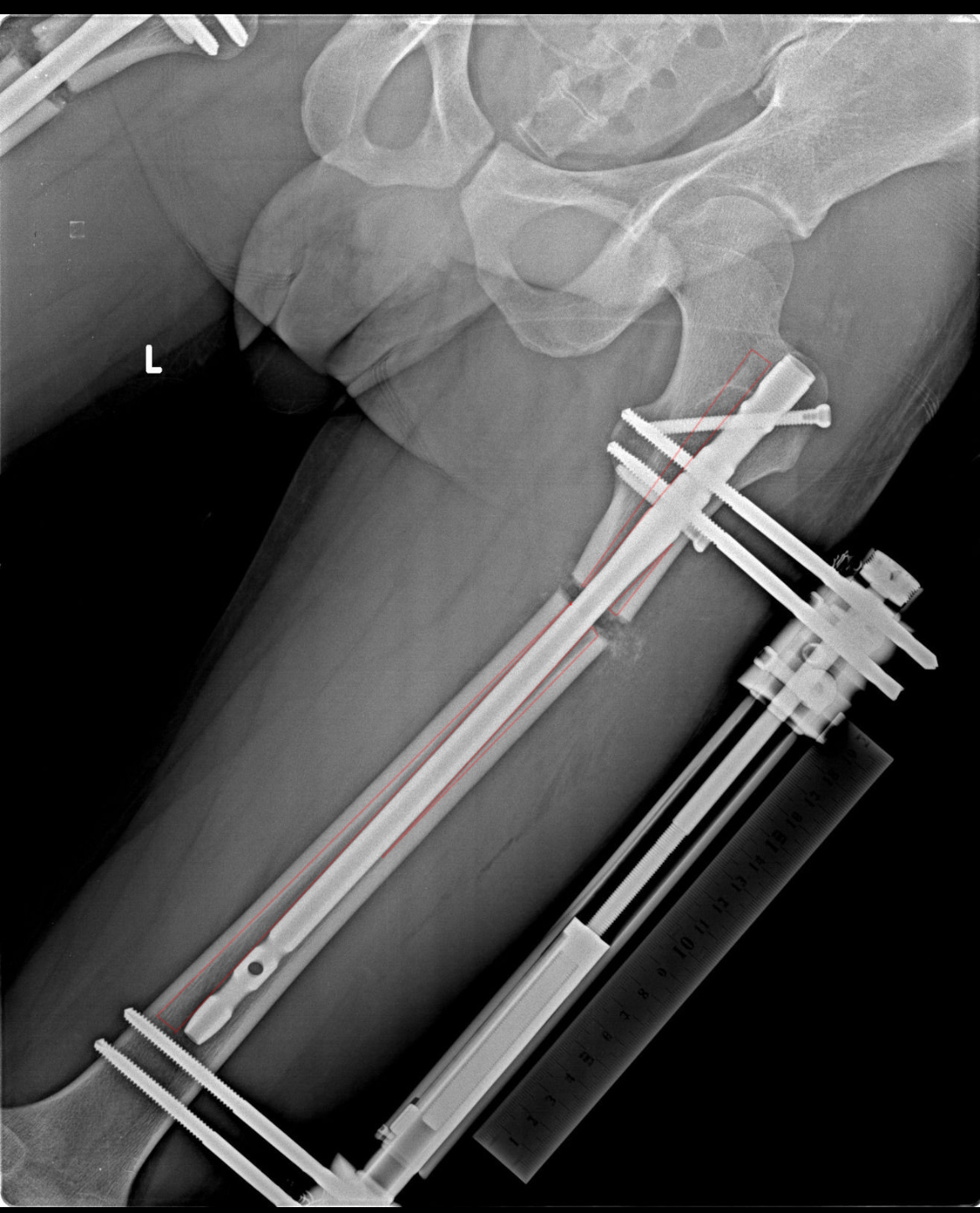 LON Femur - broken bones not straight