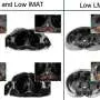 Hidden Muscle Fat Linked to Heart & Metabolic Risk