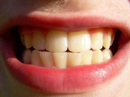 Teeth-Whitening-Sydney