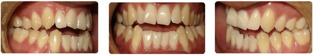 pre-ortho-gum-recession-bite