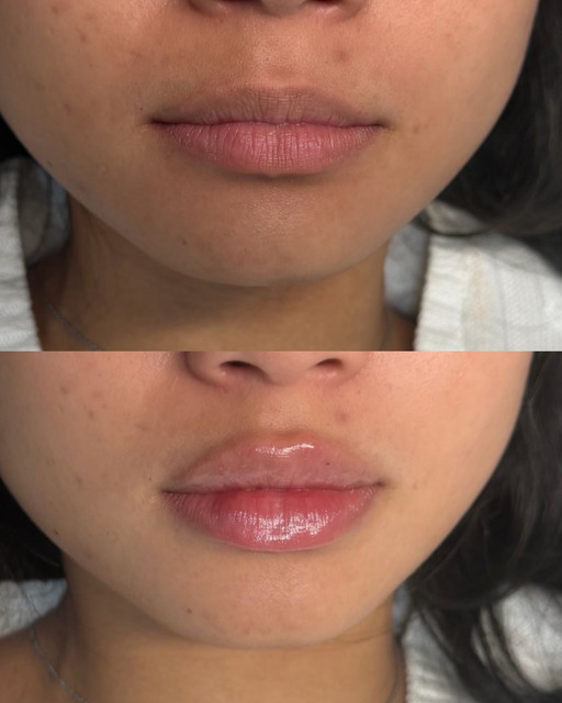 Lipparazzi Instant Filler Lips before and after