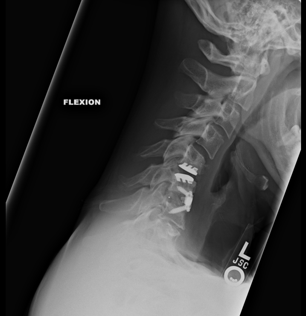 flexion