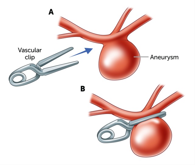 Aneurysm clipping surgery