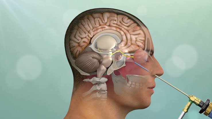 Endoscopic trans-nasal CSF rhinorrhoea repair