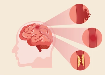 Stroke & Brain Haemorrhage