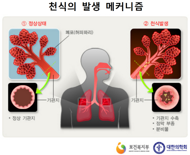 기관지 염증