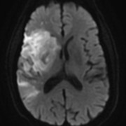 STROKE MRI 4