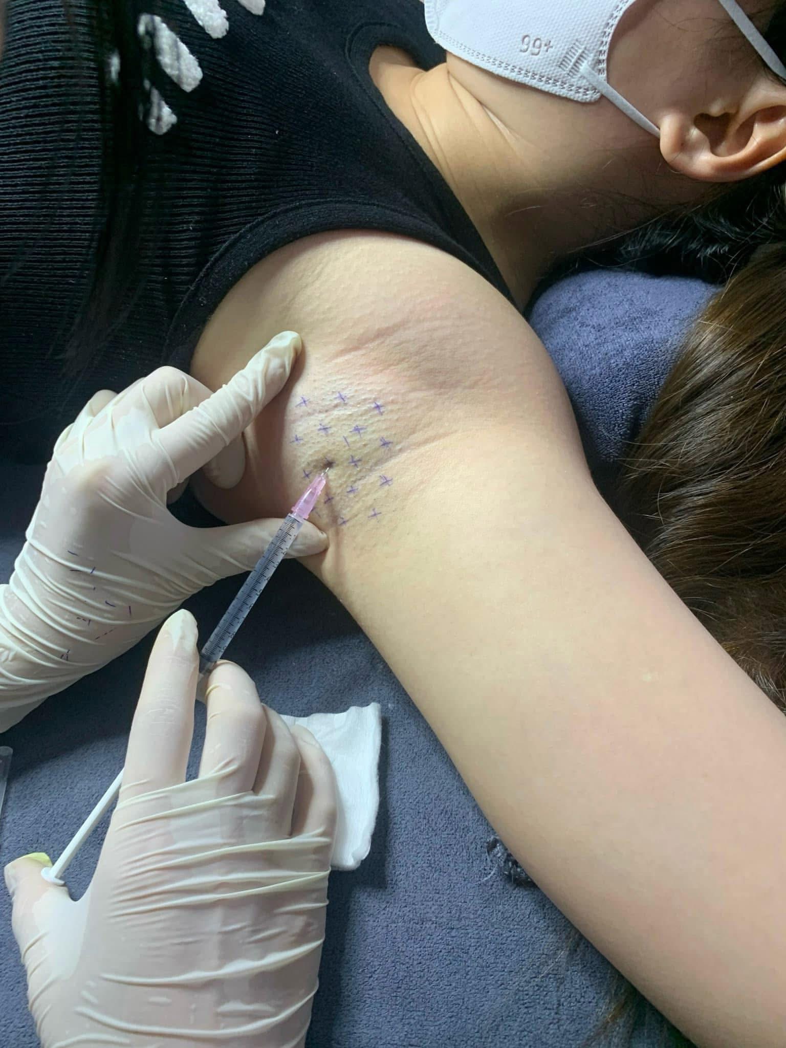 Crow's feet Botox