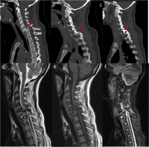Spinal cord injury management