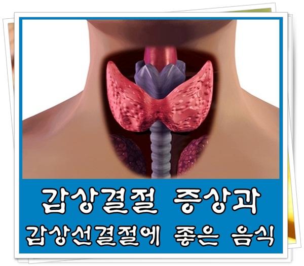 갑상선 결절에 좋은 음식