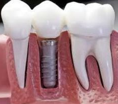 Tooth-Implant-Melbourne