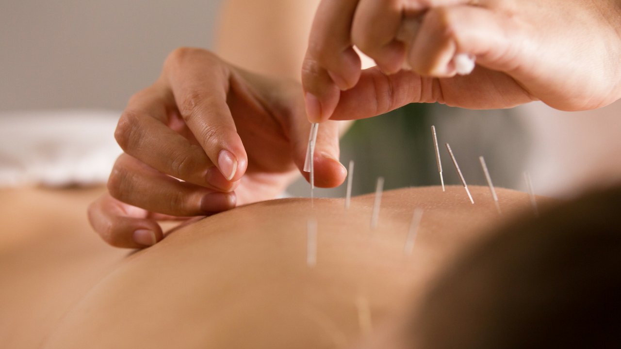 Acupuncture Therapy