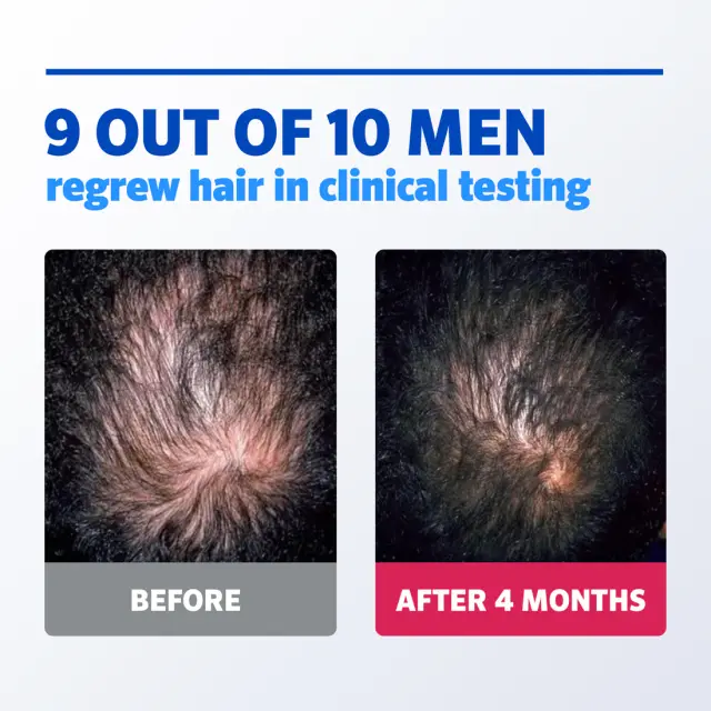 Rogaine Foam Hair Loss & Regrowth Treatment 5% Minoxidil