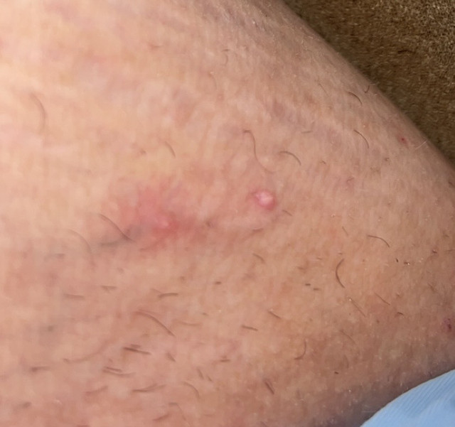 painless bumps on inner thigh